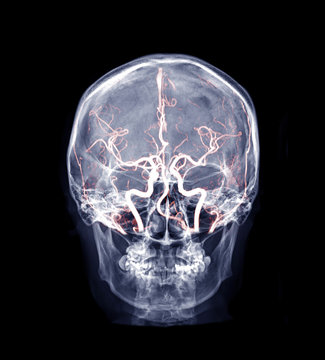  Skull x-ray image of Human skull ap mix MRA Brain image showing cerebral artery of brain in skull.