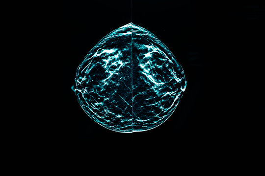 mammography