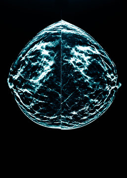 mammography