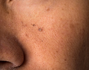 mole nevus nevo on the skin face