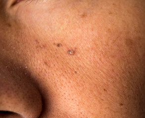 Naklejka premium mole nevus nevo on the skin face