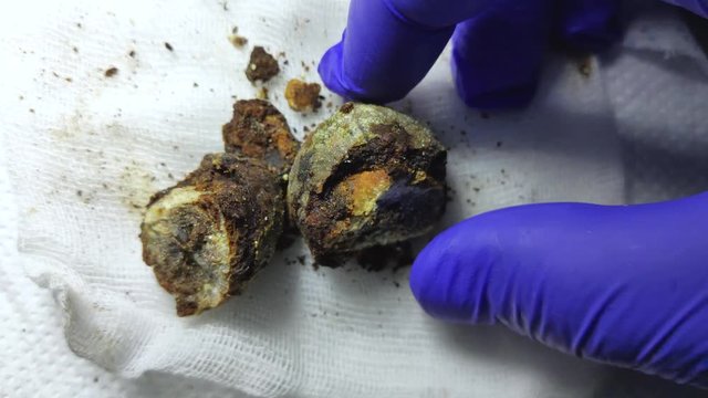 Gallstones close up. Calculi in the hands of the surgeon after laparoscopy, surgery to remove the gallbladder. Complications of gallstone disease. Cut bile crystals.