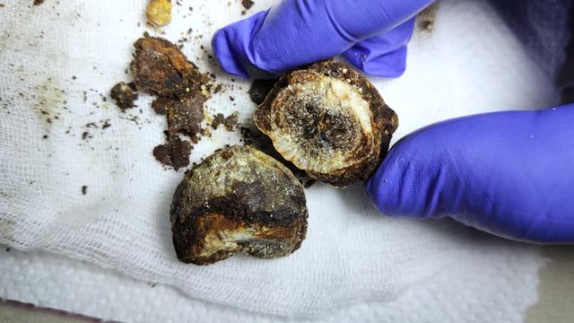Gallstones close up. Calculi in the hands of the surgeon after laparoscopy, surgery to remove the gallbladder. Complications of gallstone disease. Cut bile crystals.