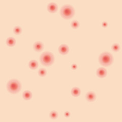 ニキビ　吹き出物　種類