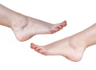 Female feet with dry skin before and after treatment or retouch.