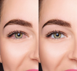 Irritated female eyes with redness before and after treatment.