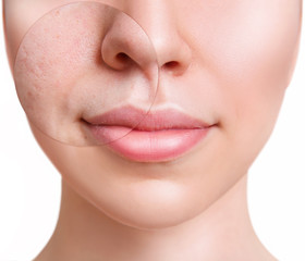 Face of young woman with zoom circle before and after treatment.