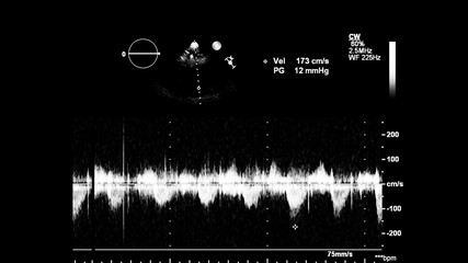 Image of the heart in gray-scale mode during transesophageal ultrasound.