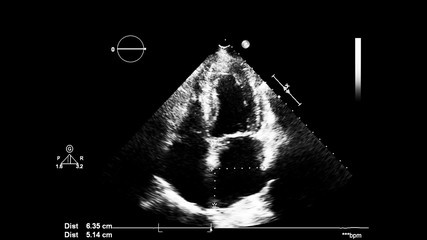 Image of the heart in gray-scale mode during transesophageal ultrasound.