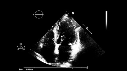 Image of the heart in gray-scale mode during transesophageal ultrasound.
