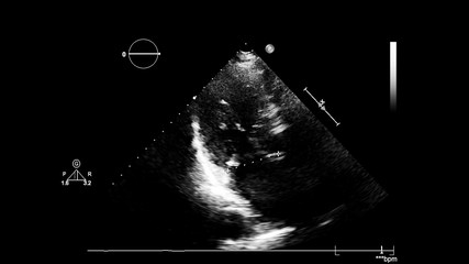 Image of the heart in gray-scale mode during transesophageal ultrasound.