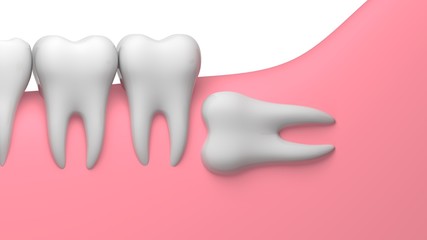 Wisdom tooth horizontal impaction illustration, 3D-rendering, white background