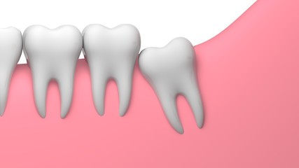 Wisdom tooth partial eruption impaction illustration, 3D-rendering, white background
