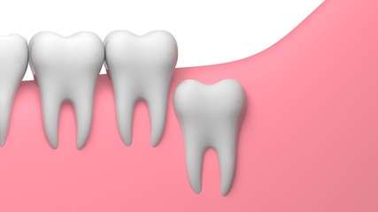 Wisdom tooth vertical impaction illustration, 3D-rendering, white background