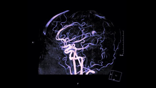 MRA Brain or Magnetic resonance angiography  turn around right to left on the screen for evaluate cerebral artery disease.