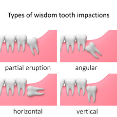 Types of wisdom tooth impactions, white background, collage, 3D-render illustration