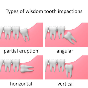 normal wisdom teeth growth