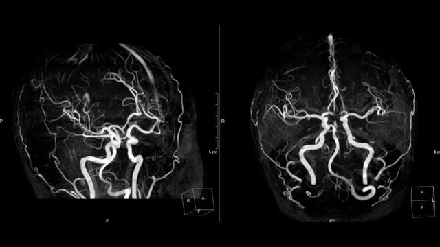 MRA Brain or Magnetic resonance angiography compare right to left and Foot to head  turn around on the screen for evaluate cerebral artery disease.