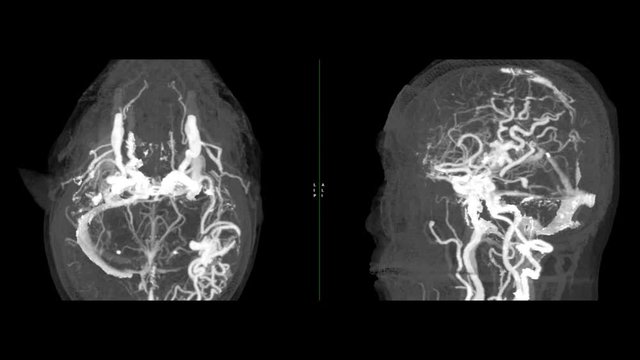 CTA Brain or computed tomography angiography of the brain 3D  MIP  image  showing Brain AVM or arteriovenous malformation turn around on the screen.