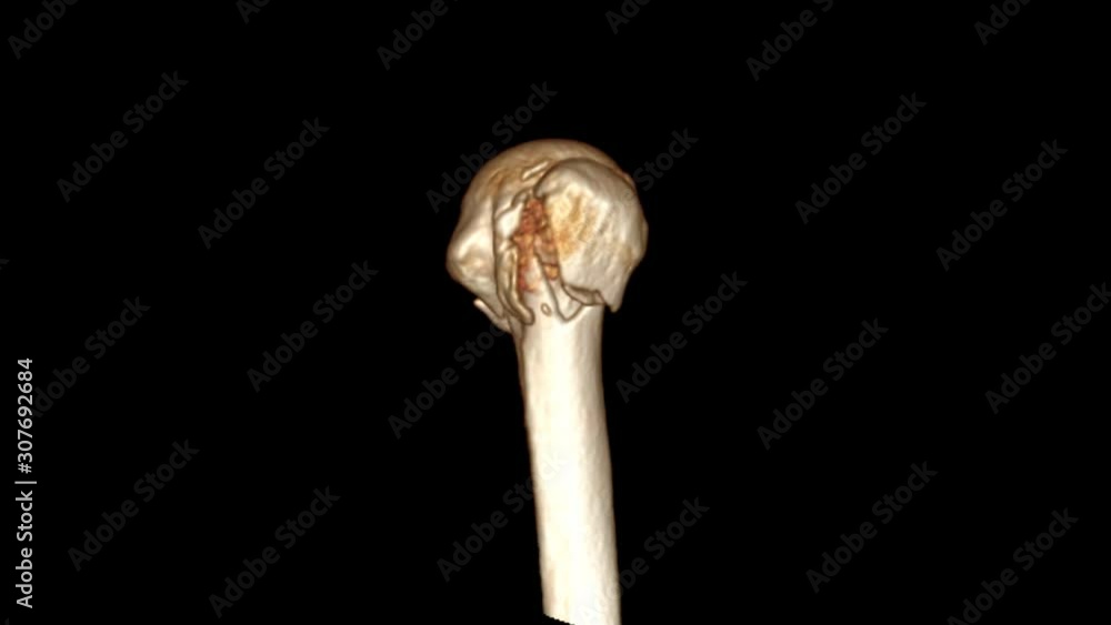Poster ct elbow 3d rendering image turn around on the screen showing fracture head of humerus bone.