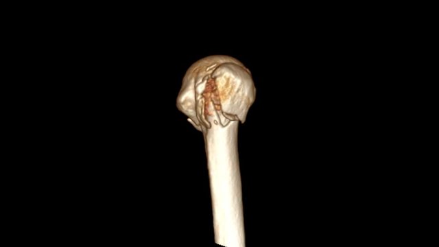 CT Elbow 3D rendering image turn around on the screen showing fracture head of  humerus bone.
