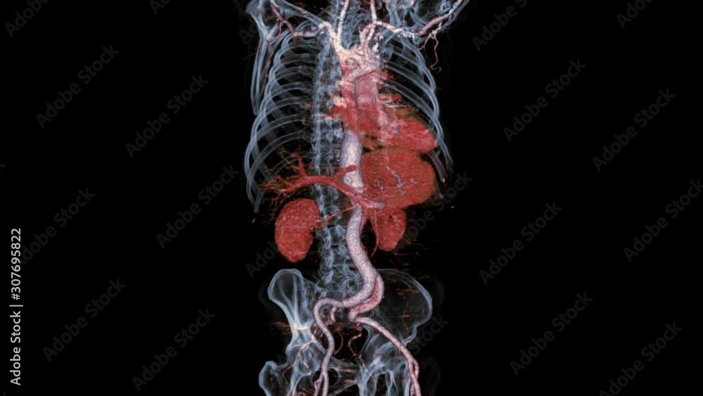 Poster cta whole aorta 3d rendering image turn with skeleton transparent turn around on the screen for dete