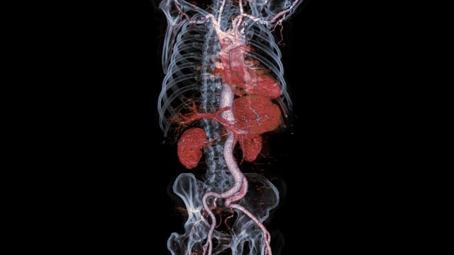 CTA Whole aorta 3D rendering image turn with skeleton transparent turn around on the screen for detect aortic aneurysm.