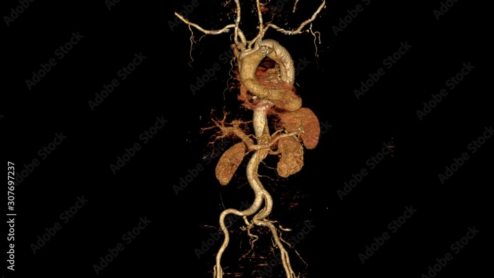 Poster cta whole aorta 3d rendering image turn around on the screen for detect aortic aneurysm.