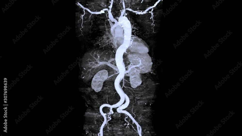 Poster cta whole aorta 3d rendering image turn around on the screen showing aortic dissection.