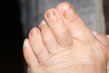 human foot with toenail fungus