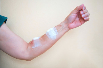 The bandage from hemodialysis to the arm from the treatment of dialysis through a blood vessel 