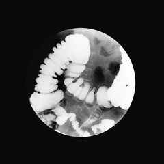 Fluoroscopic examination of lower gastrointestinal (GI) Tract, a spot film of lower...