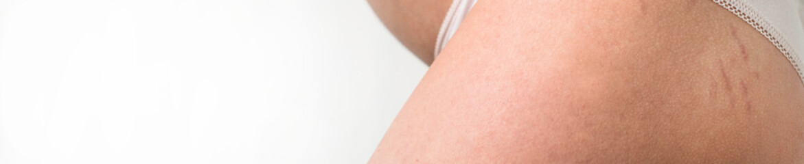 Young woman shows her cellulite and stretch marks on white isolated background.
