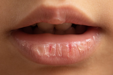 natural remedies for chapped lips at a young age, concept of skin care - obrazy, fototapety, plakaty
