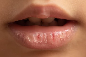 Fotobehang natural remedies for chapped lips at a young age, concept of skin care © Alessandro Grandini