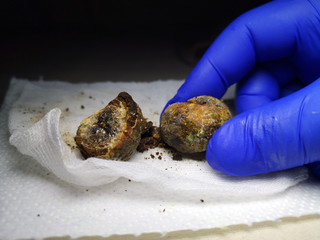 Gallstones close up. Calculi in the hands of the surgeon after laparoscopy, surgery to remove the...