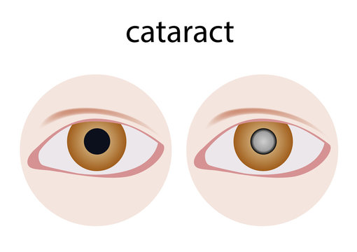 Top 8 bệnh lý khiến mắt mờ dần cần chú ý để tránh mù lòa