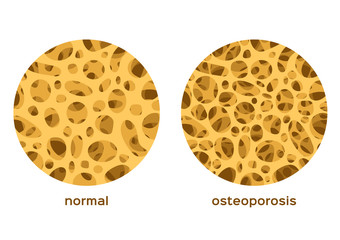 osteoporosis bone graphic vector / low density human calcium / anatomy