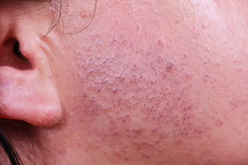 Skin face after removing hair