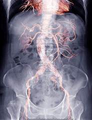 X-ray Abdomen  with mix cta whole aorta showing abdominal aorta and stent graft in abdomen for...