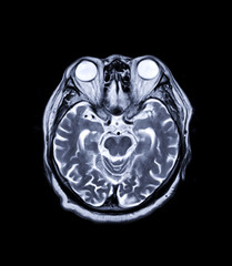 MRI brain Axial  T2 technique  for detect a variety of conditions of the brain such as cysts,...