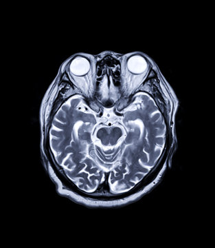 MRI brain Axial  T2 technique  for detect a variety of conditions of the brain such as cysts, tumors, bleeding, swelling, developmental and structural abnormalities, infections.
