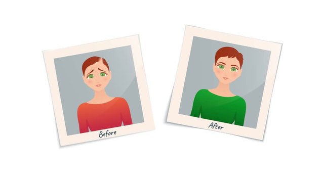 Woman before and after hair transplantation treatment. Cartoon animation of two pictures. Female hair loss  motion design graphics. Beauty transformation and medical concept. 