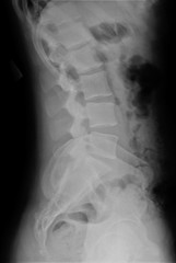 radiograph of lumbar and sacral spine in lateral projection, medical diagnostics
