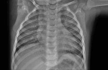 normal radiography of chest organs in direct projection,  pulmonology