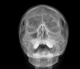 Fototapeta na wymiar radiography of the paranasal sinuses of the skull, medical diagnosis