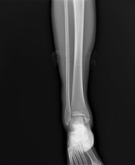 radiograph of the ankle joint  with a fracture of the outer ankle without displacement, traumatology, medical diagnostics