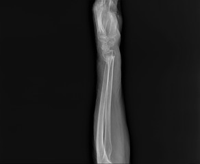 radiography of forearm and wrist bones   with a fracture of the distal radius, traumatology and orthopedics