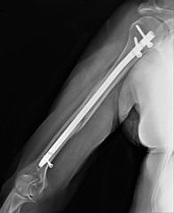 x-ray of a fracture of the humerus ,the osteosynthesis intramedullary. Traumatology and orthopedics, medical diagnostics