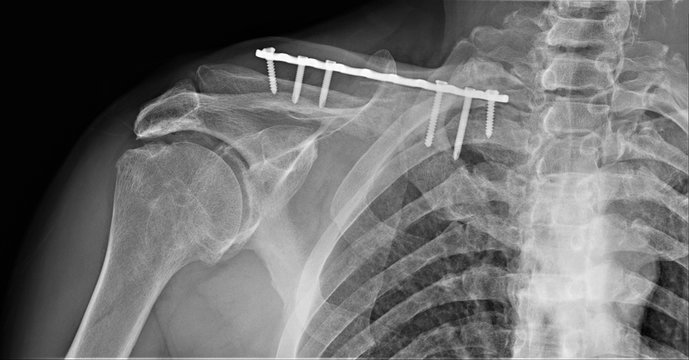 radiography of the shoulder joint and ribs in direct projection with a fracture of the clavicle fixed by a metal plate, osteosynthesis Traumatology and orthopedics